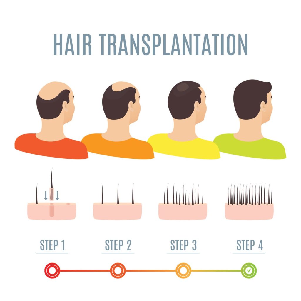 Schritte der Haartransplantation